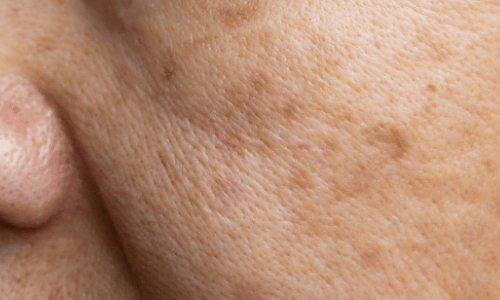 Pigmentation Treatment