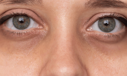 Dark Circles Treatment